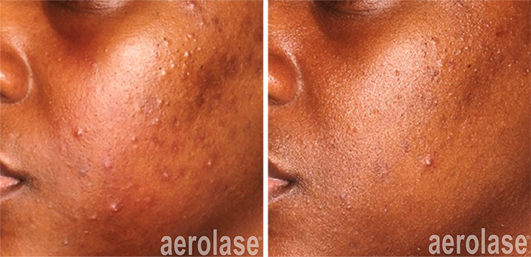 Acne Skin Rejuvination